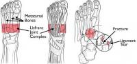 Diagram of the Lisfranc (midfoot) joint complex
